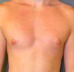 Gynecomastia (male breast reduction)