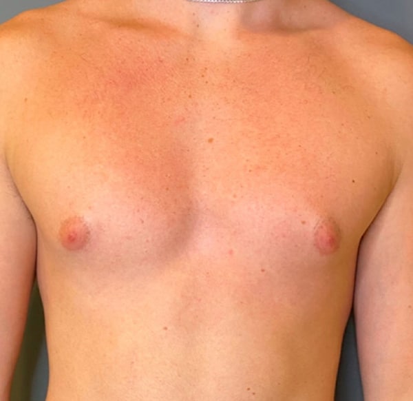 Gynecomastia (male breast reduction)