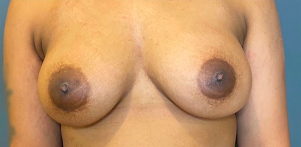 Nipple and Areola Surgery