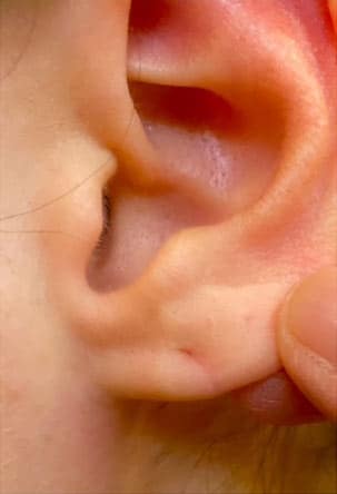 Earlobes