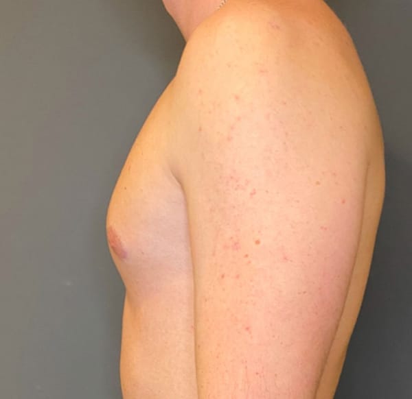 Gynecomastia (male breast reduction)