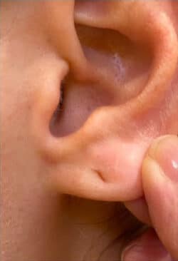 Earlobes