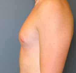 Gynecomastia (male breast reduction)