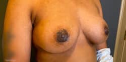 Nipple and Areola Surgery
