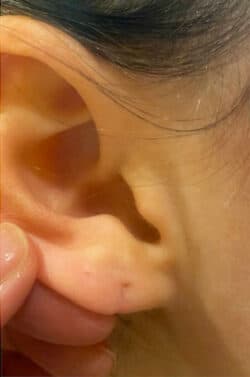 Earlobes