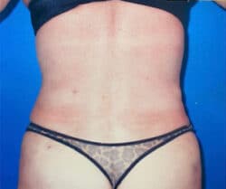Tummy Tuck