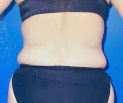 Tummy Tuck