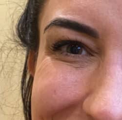 BOTOX-Dysport
