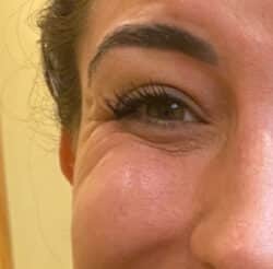 BOTOX-Dysport