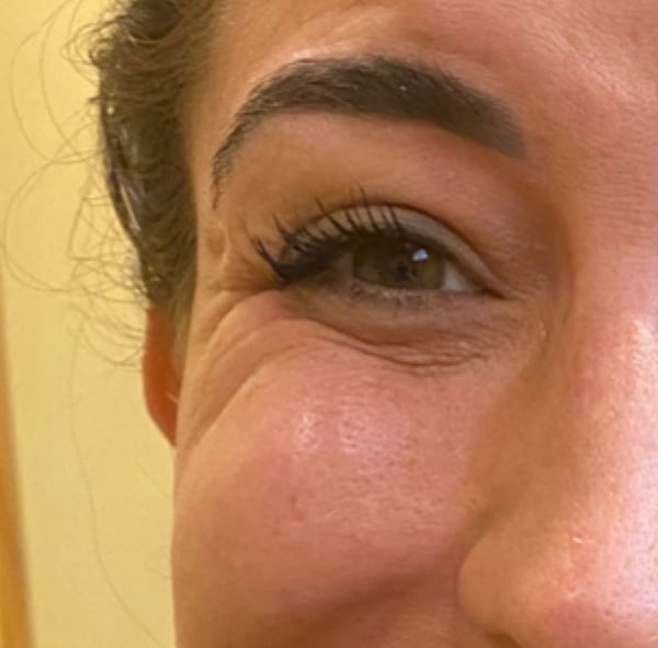 BOTOX-Dysport