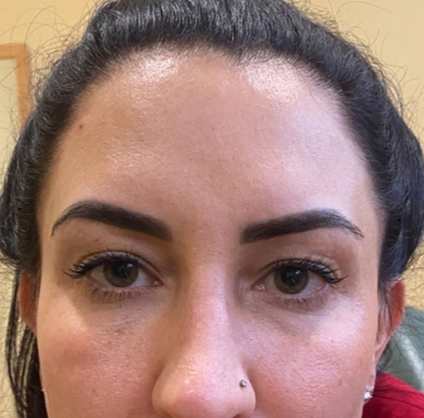 BOTOX-Dysport