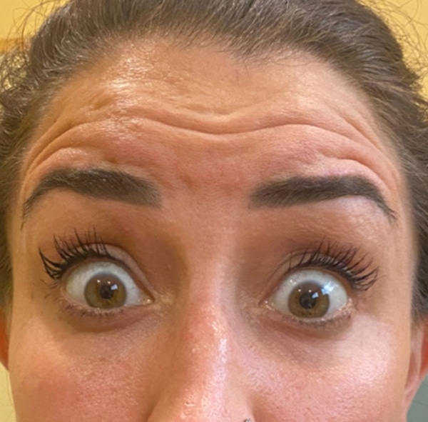 BOTOX-Dysport