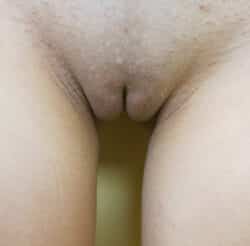 Labiaplasty