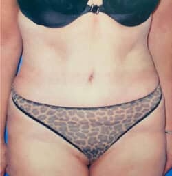 Tummy Tuck