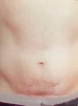 Tummy Tuck