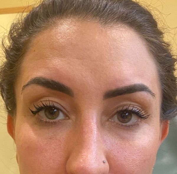 BOTOX-Dysport