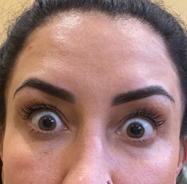 BOTOX-Dysport