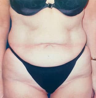 Tummy Tuck