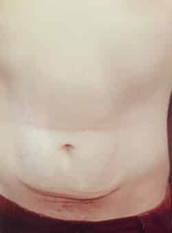 Tummy Tuck