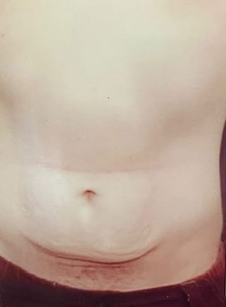 Tummy Tuck