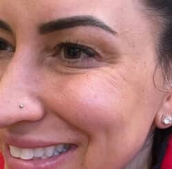 BOTOX-Dysport