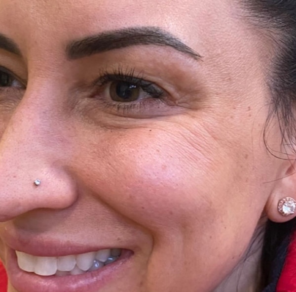 BOTOX-Dysport