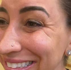 BOTOX-Dysport