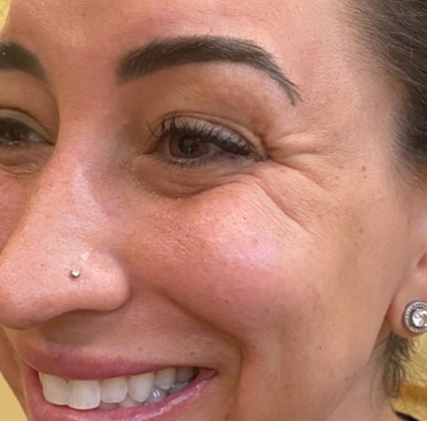 BOTOX-Dysport