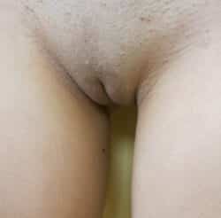 Labiaplasty