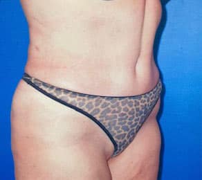 Tummy Tuck