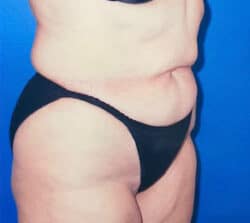 Tummy Tuck