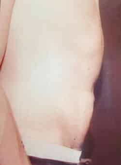 Tummy Tuck