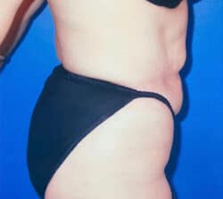 Tummy Tuck