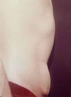 Tummy Tuck