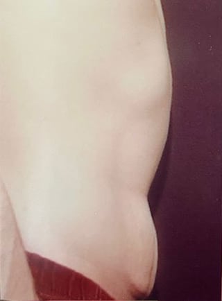 Tummy Tuck