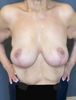 Breast Lift