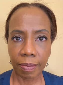 Eyelid Tuck