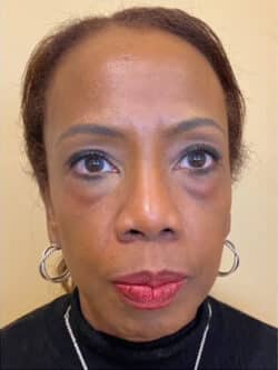 Eyelid Tuck