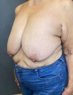 Breast Lift