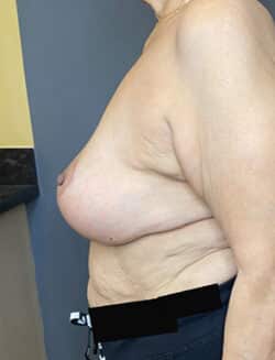 Breast Lift