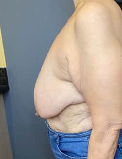 Breast Lift