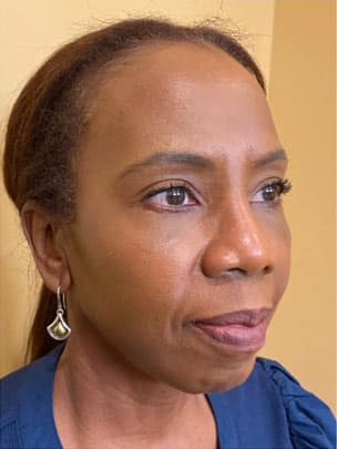 Eyelid Tuck