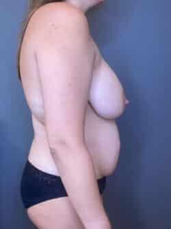 Breast Reduction (female)