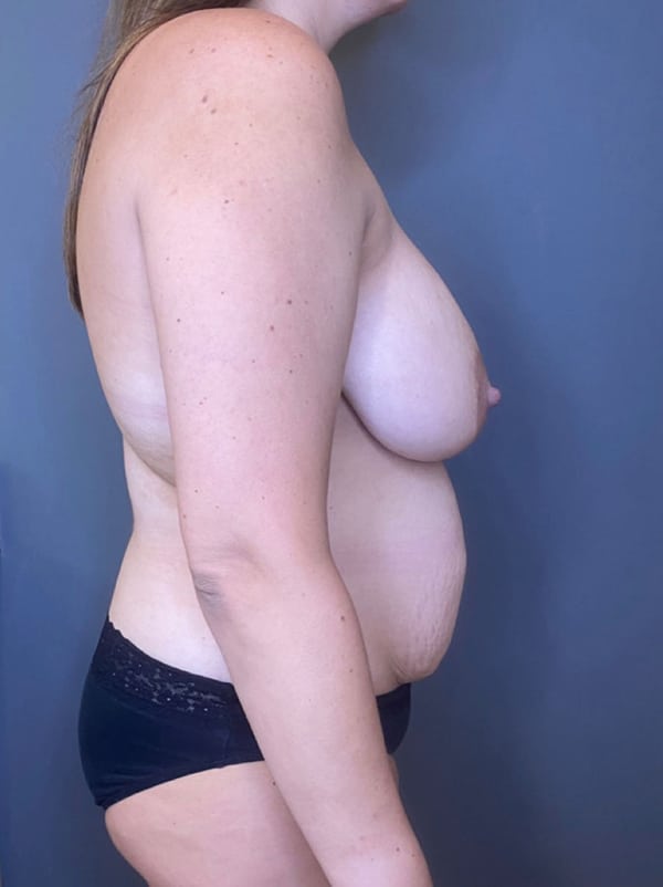 Breast Reduction (female)