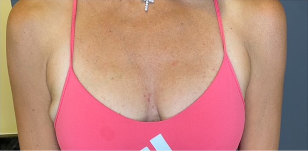 Breast Fat Grafting