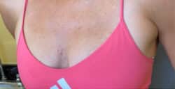 Breast Fat Grafting