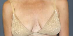 Breast Fat Grafting