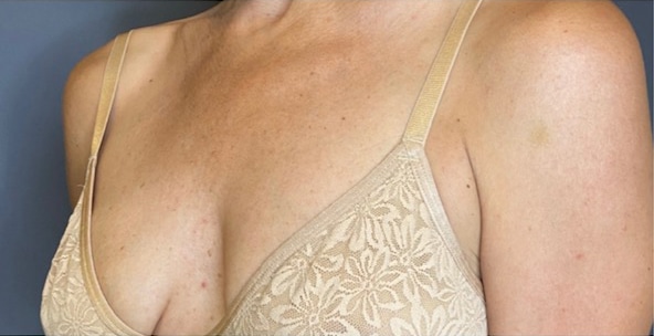 Breast Fat Grafting