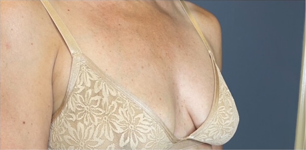 Breast Fat Grafting