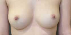 Nipple and Areola Surgery
